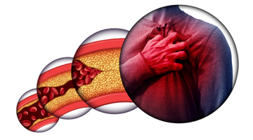Atherosclerosis, Oxidative Stress, and Antioxidants